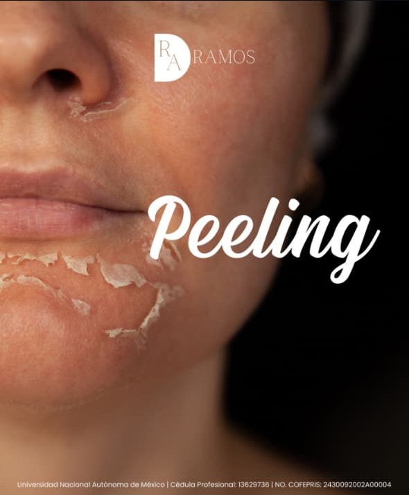 Peeling químico facial